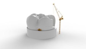 implant dentar